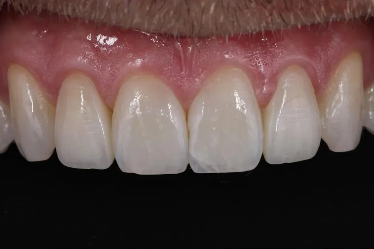 Case-18-After-768x512