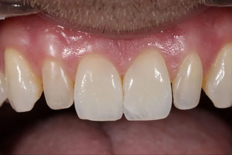 Case-18-Before-768x512