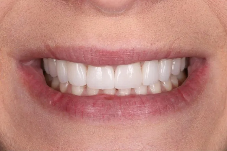 Case-21-After-768x512