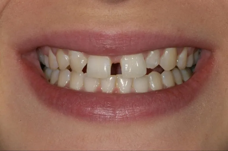 Case-21-Before-768x511