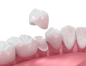 Same-Day Dental Crowns Vs. Traditional in Arlington Heights, IL