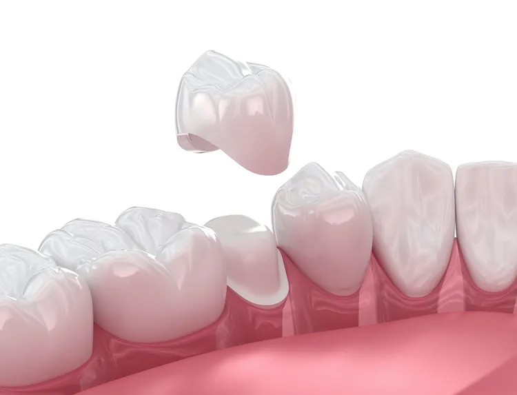 Same-Day Crowns Vs. Two-Week Crowns: Which One Actually Fits Better?